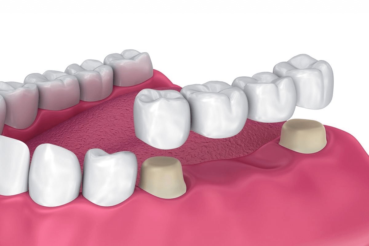 Dental bridge diagram