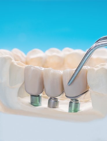 Dental bridge implant procedure