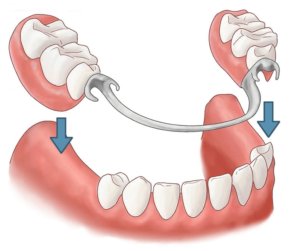 Partial denture diagram