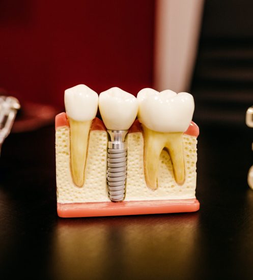 Dental implant model — lost filling or crown