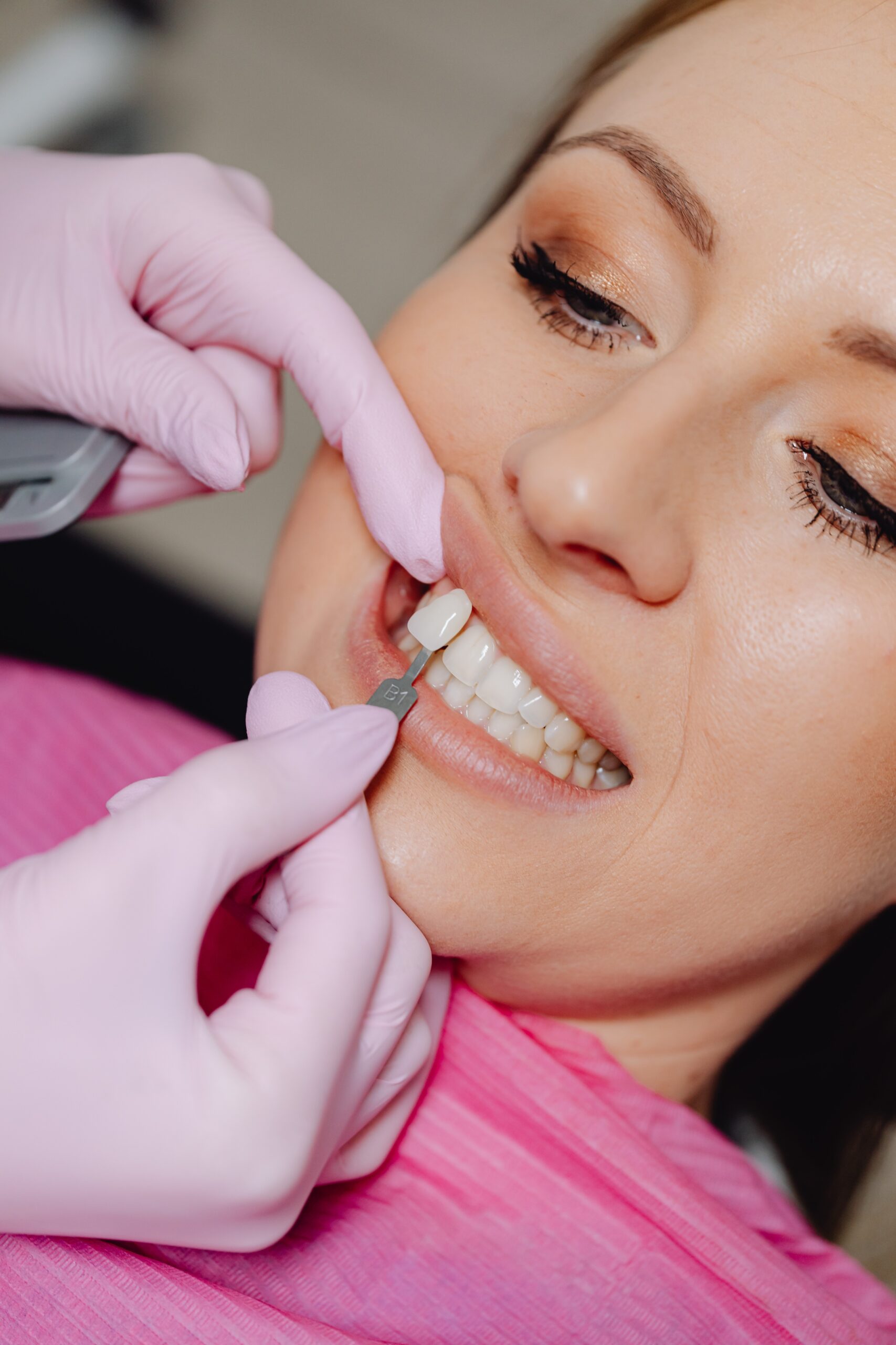 Dental Bonding shade matching