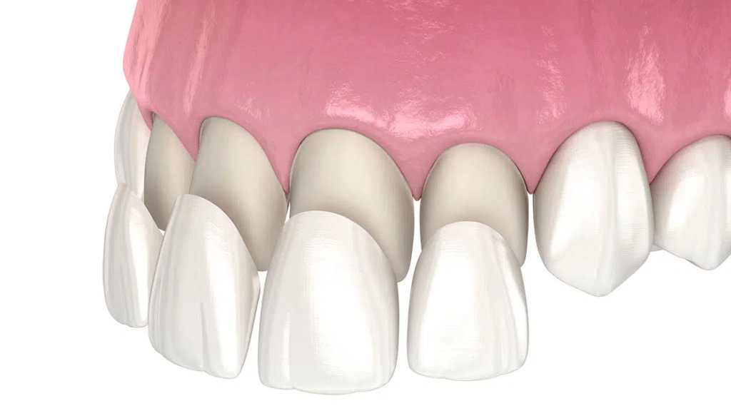 Porcelain Veneers diagram